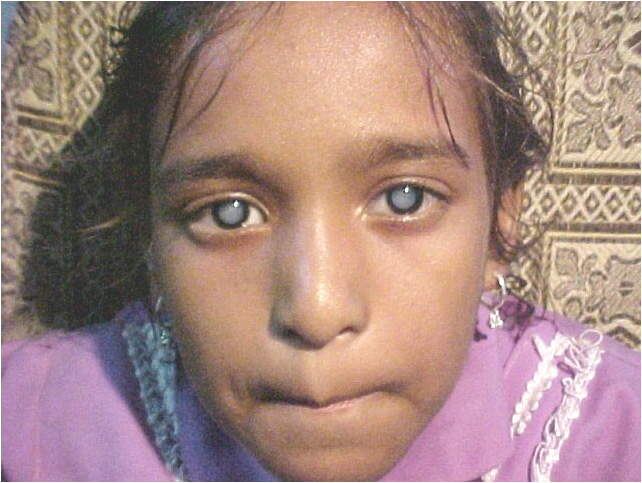 Young girl with cataracts in both eyes